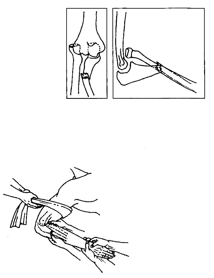 尺骨上段骨折